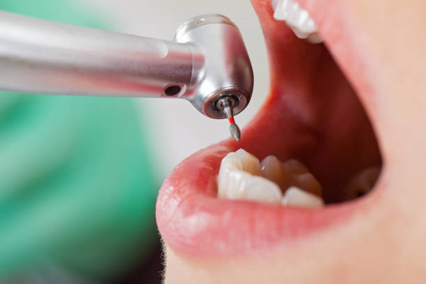 Best Emergency Dentist for Lost Fillings or Crowns in Coord, NC